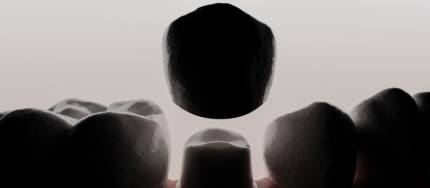 Dental Implants: All You Need to Know